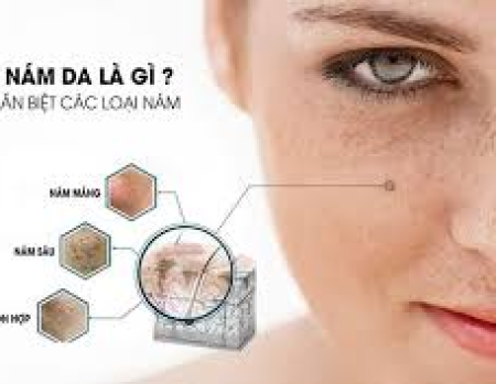 Kiến Thức Về Da Nám