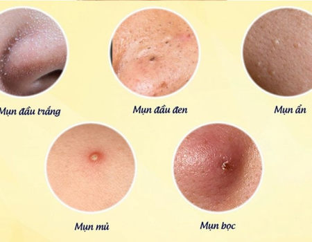 Kiến Thức Về Da Mụn